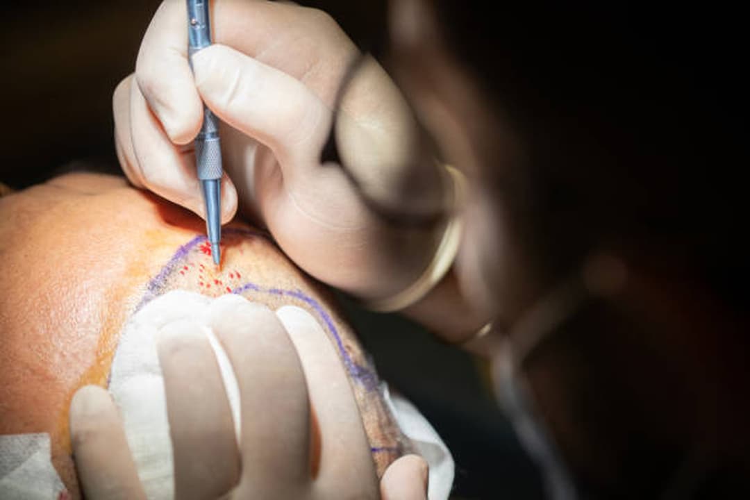 Sapphire Hair Transplant